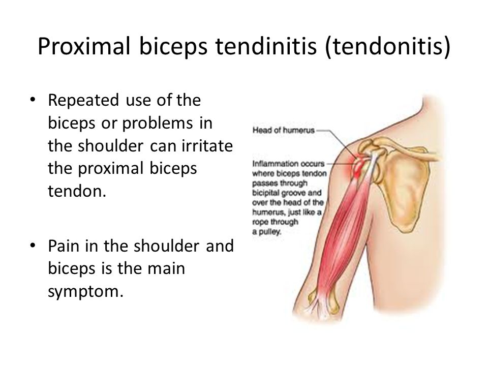 Repeated use of the biceps or problems in the shoulder can irritate the proximal biceps tendon. Pain in the shoulder and biceps is the main symptom.